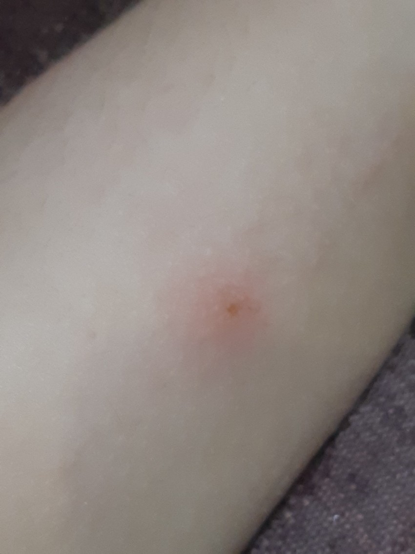 Deci se nakon ujeda komarca pojavi otok i plik