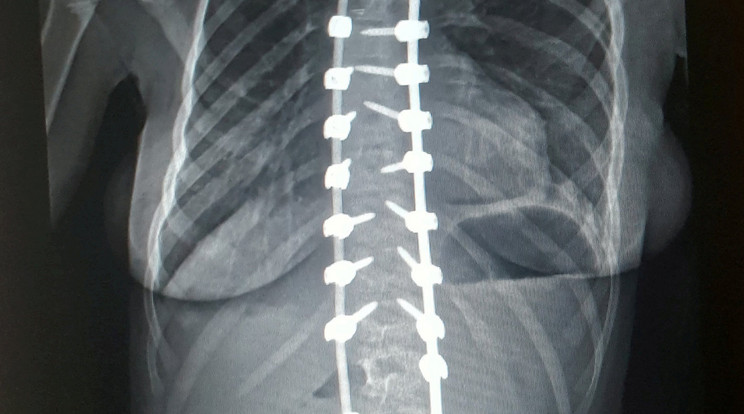 Automatizált gerinctörés-diagnosztikai platformot hoznak létre Magyarországon / Illusztráció: Northfoto