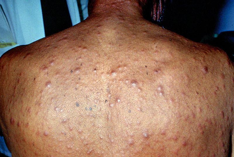 secondary-syphilis-rash-stock-image-m862-0055-science-photo-library