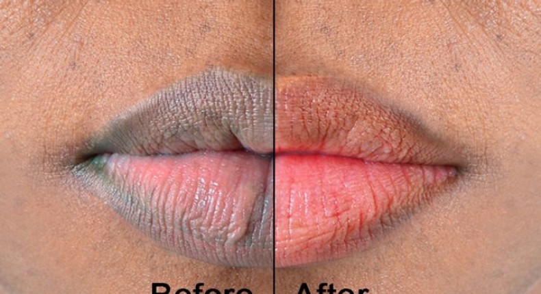 8 food varieties to assist you with disposing of dim lips