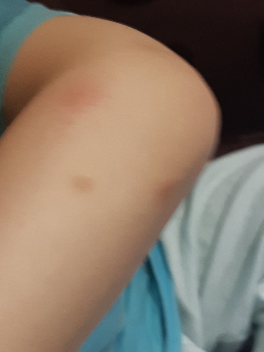 Burna reakcija na ujede komaraca 