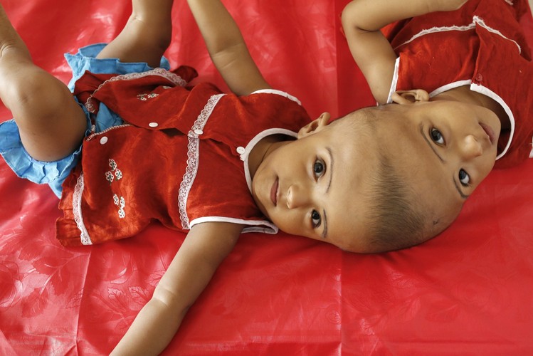 DZIEWCZYNKI ZŁĄCZONE GŁÓWKAMI. ZDOŁAJĄ JE ROZDZIELIĆ?