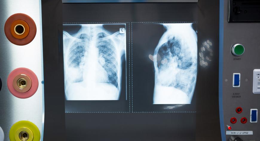 Tętnicze nadciśnienie płucne to rzadka postać dużej grupy chorób przebiegających z podwyższonym ciśnieniem w tętnicach płucnych.