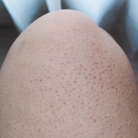 Grízes bőr: a keratosis pilaris oka, tünetei és kezelése