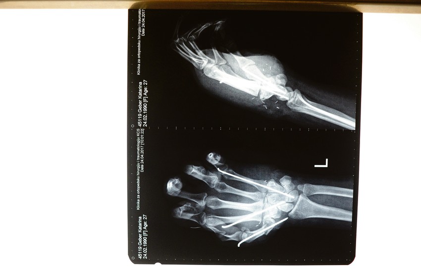 Posebnim iglama lekari su fiksirali kosti i krenuli na ušivanje tetiva. Za svaki prst ušili su najmanje dve tetive, ukupno više od 10