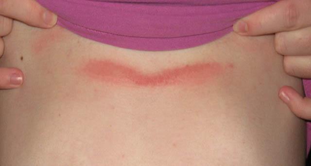 vörös foltok a nyakon az izgalmi kezeléstől pikkelysömör kezelése udalyanchi véleményekben