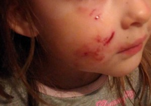 Cerka MM posle napada psa lutalice , Valjevo