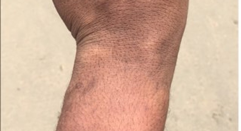 Bruises from the alleged police assault