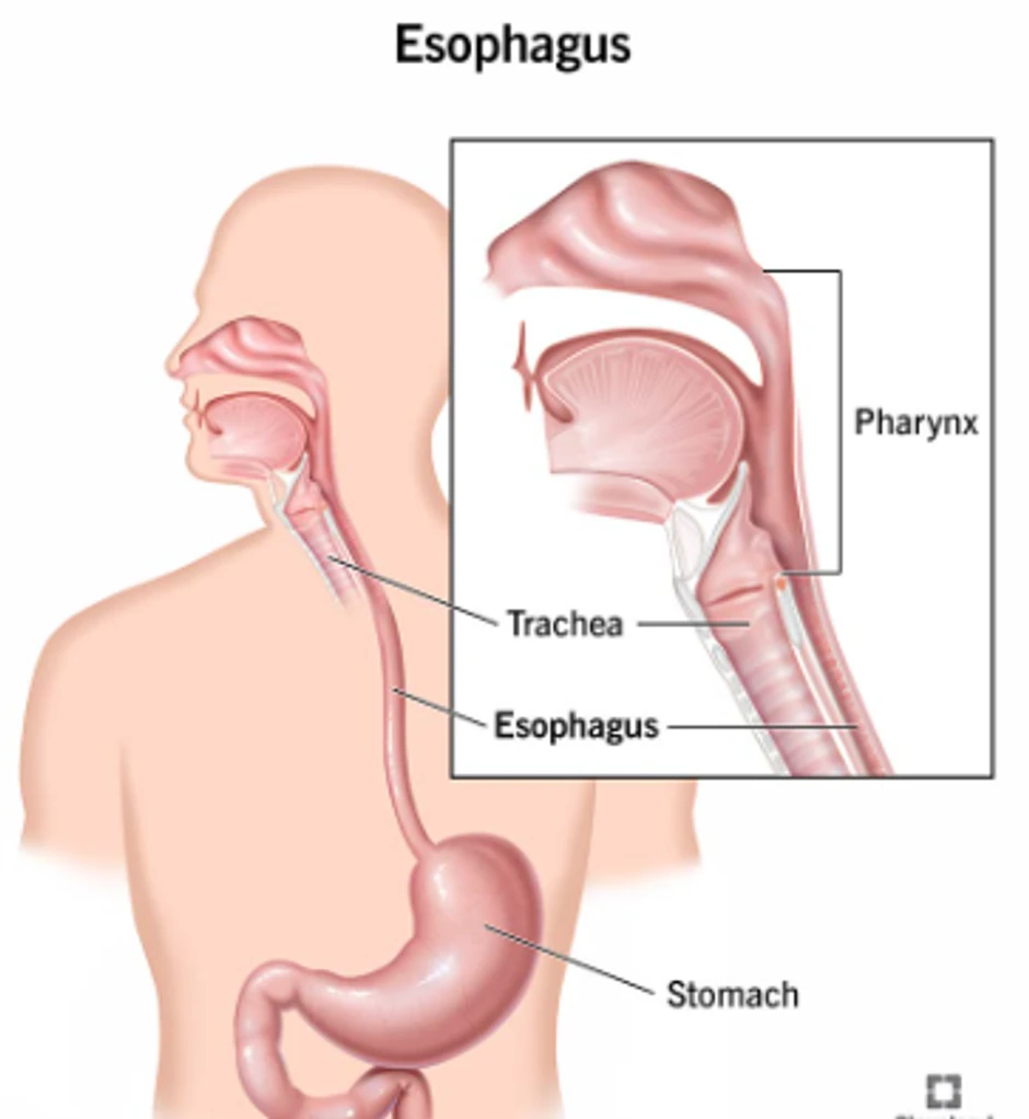 Kada je zid jednjaka pocepan, hrana, hemikalije i bakterije iz gastrointestinalnog trakta mogu da prodru u grudi