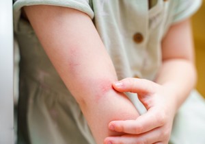 Za trudnice i dojilje koje imaju hereditarni angioedem nedostaje profilaktička terapija 