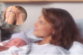 Zbog TRUDNIČKE TERAPIJE leva dojka joj je TOLIKO PORASLA, da je bila VEĆA OD BEBE koju je rodila: Doktori su slučaj opisali kao NAJEKSTREMNIJI U ISTORIJI