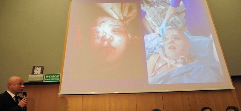 Drugi przeszczep twarzy w Polsce. Operowano dziewczynę z nowotworem