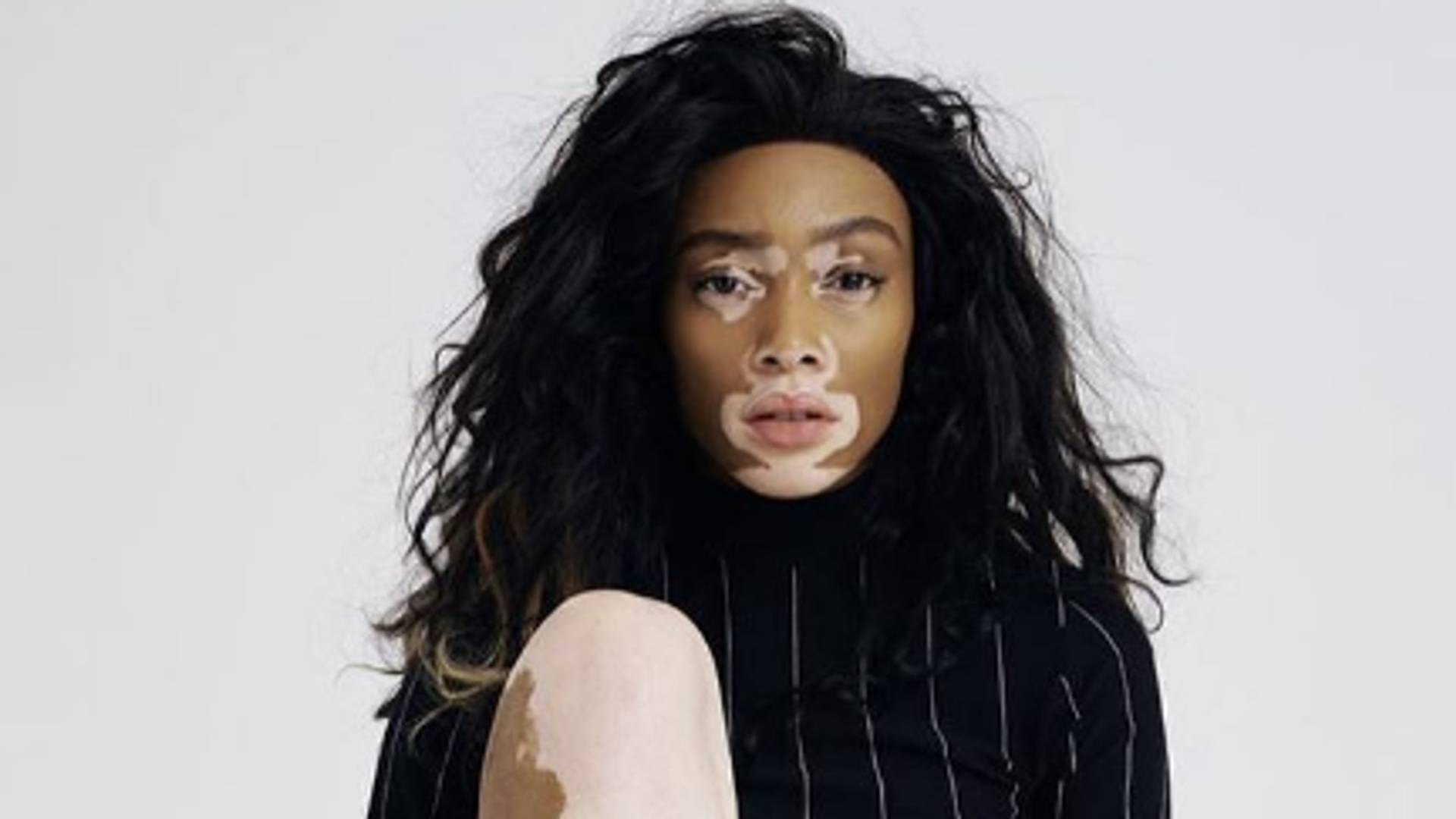 Winnie Harlow o samopouzdanju, vitiligu i planovima za budućnost