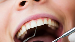 Jak dbać o zęby z protezą częściową? 