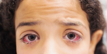 Nem múló kötőhártya gyulladás: mi számít annak, és mit lehet ilyenkor tenni?
