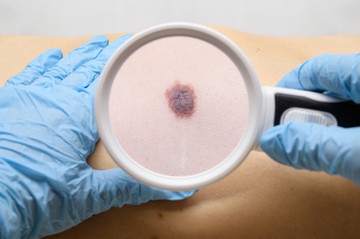 Melanoma, bőrrák, tünet