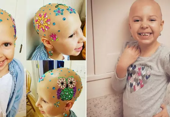 Córeczka cierpi na łysienie (alopecję), mama pomaga znosić chorobę w najpiękniejszy możliwy sposób