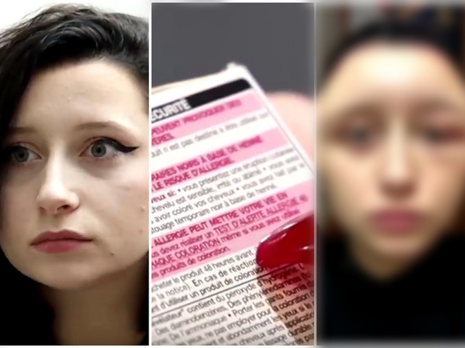 Estel je umalo umrla zbog jake alergijske reakcije