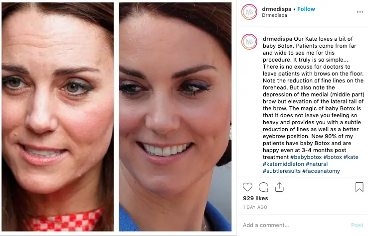 Kate Middleton - baby botox fot. drmedispa/ Instagram