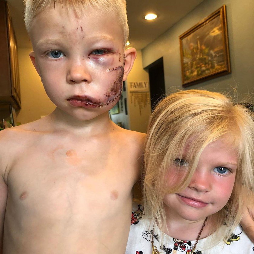 6-latek odniósł straszne rany, bo osłaniał siostrzyczkę. Pokazali jak teraz wygląda
