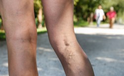 To możesz zrobić już! Jak leczyć żylaki nóg domowymi sposobami?