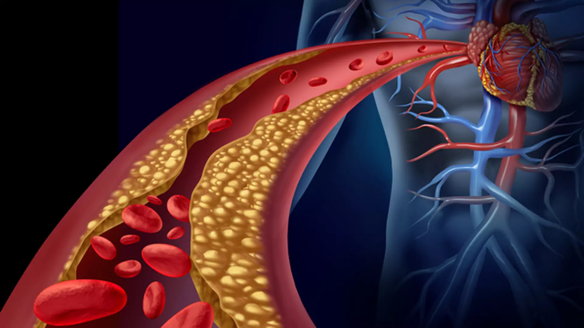 Cholesterol LDL – jakie są jego normy. Dieta obniżająca "zły cholesterol"