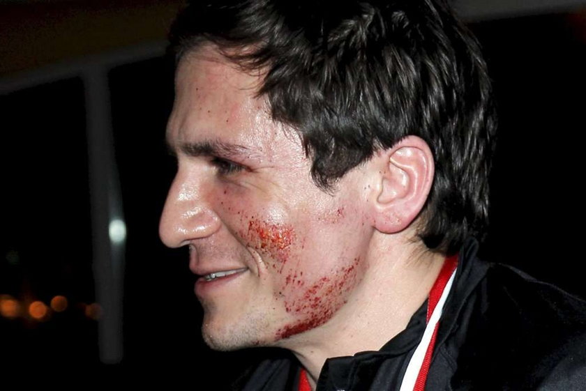 Polski aktor miał wypadek na nartach. Jest ranny. Foto