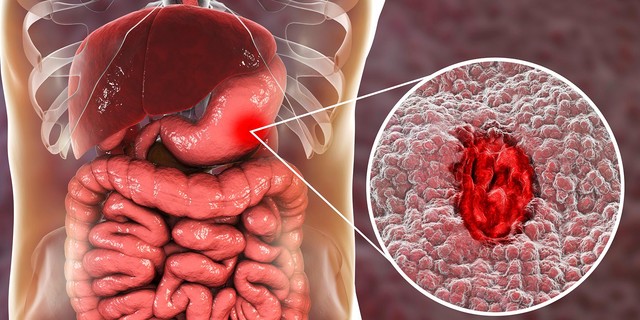 6 Symptoms of stomach ulcer | Pulse Nigeria