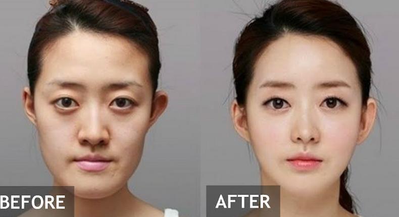 A South Korean lady before and after surgery [Koreaboo]