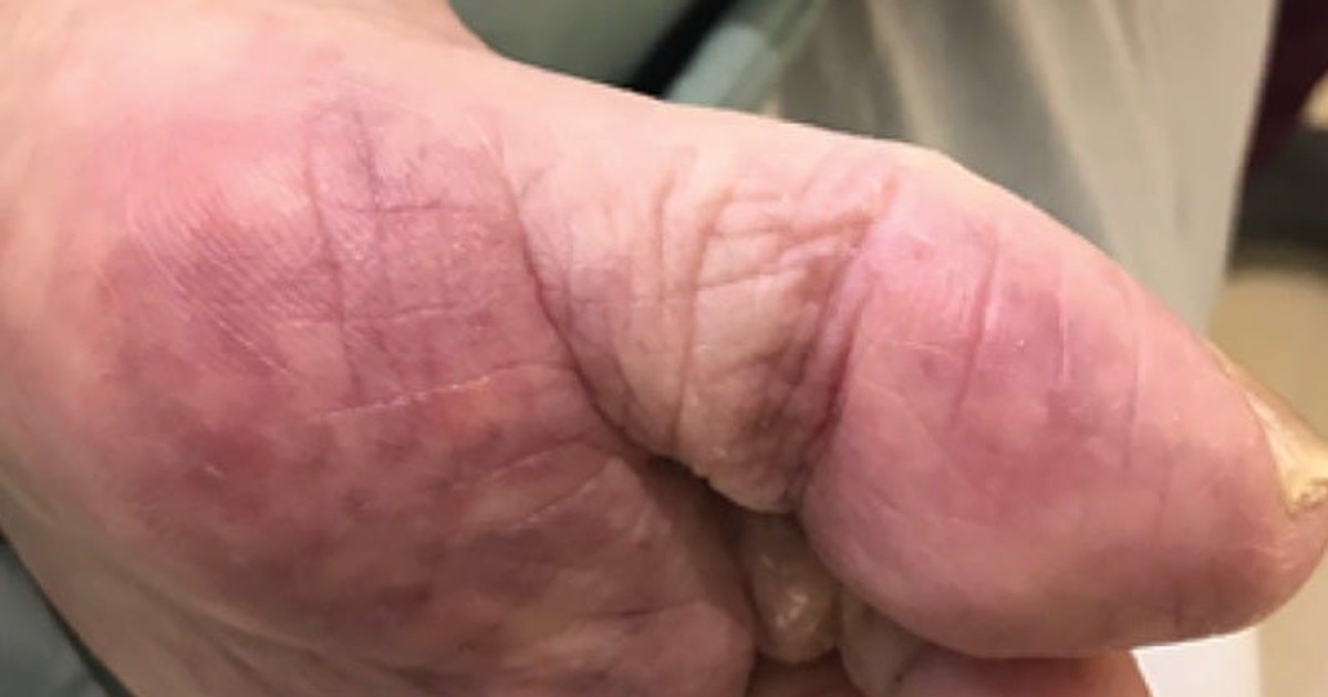 Some coronavirus patients develop rashes, skin-reddening, and lesions ...