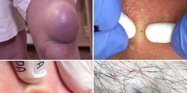 The best pimple popping videos of 2018, from a 50-year-old blackhead to a  cottage cheese leg cyst | Pulse Nigeria