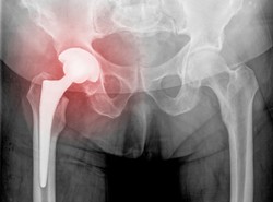 Osteoporoza groźniejsza niż rak? Lekarze alarmują