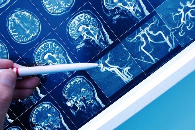Magyar felfedezés mutathat új irányt a stroke és a demencia gyógyításában