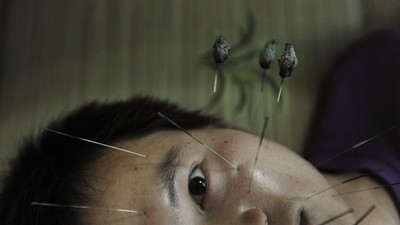 A patient suffering from facial paralysis undergoes acupuncture treatment at a traditional Chinese m