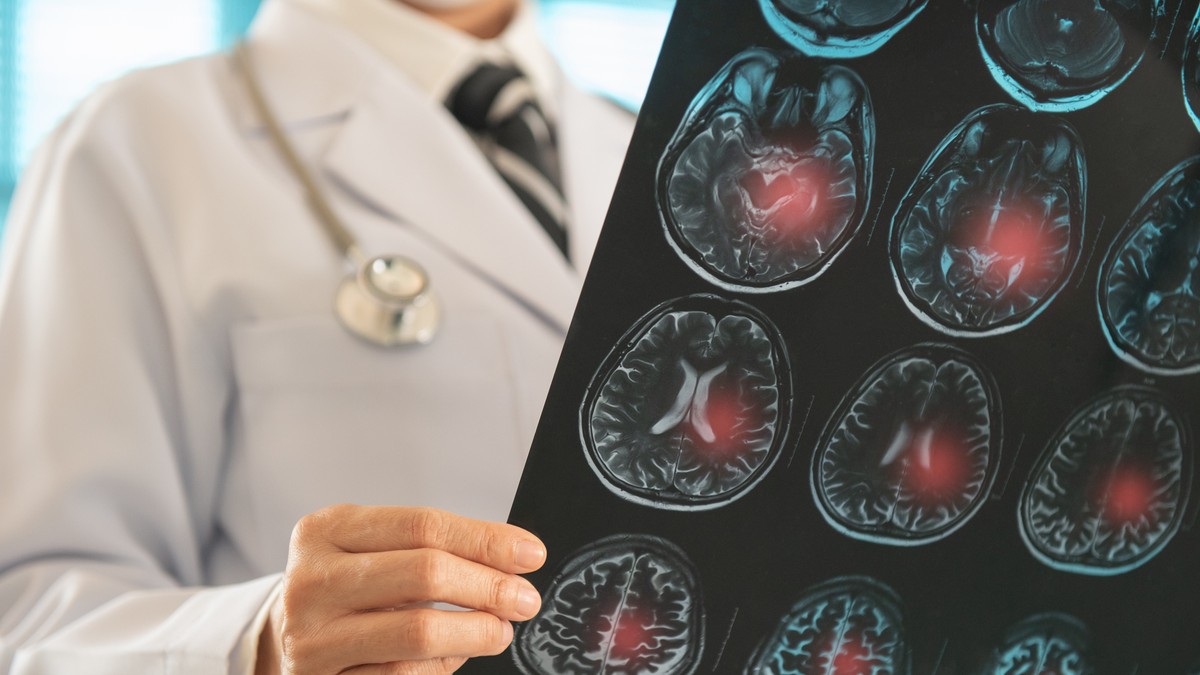 Lakunarni moždani udar  je po život opasno medicinsko stanje 