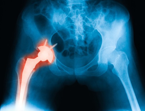 csont-implantatum