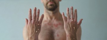 A pénisz duzzanatát és a végbélfájdalmat is a majomhimlő tüneteiként azonosították