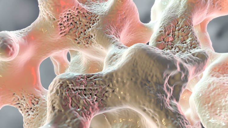 mi az osteoporosis csontritkulás ok tünet kezelés