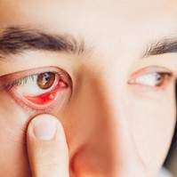 Árpa a szemen: ilyen tünetek mellett mindenképp forduljon orvoshoz!