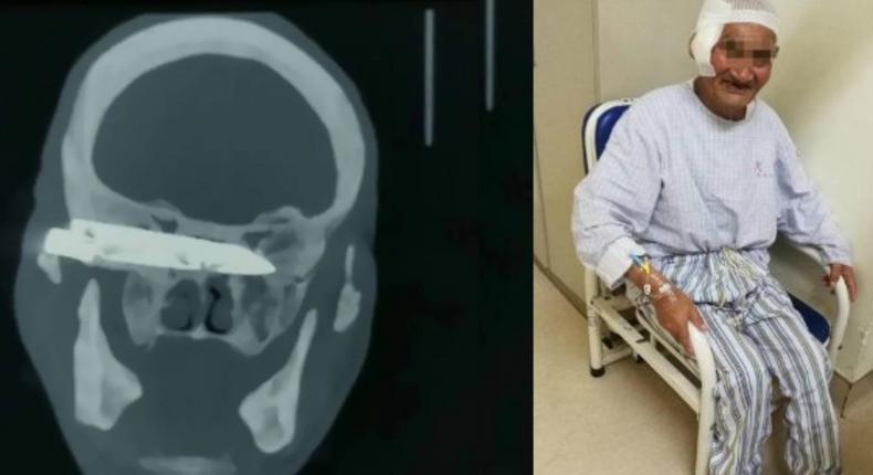 Doctors remove 4-inch-long rusty knife from man’s head 26 years after he was stabbed (photos)