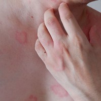Az anafilaxia tünetei két hullámban jelentkezhetnek! Erre figyelmeztet az allergológus