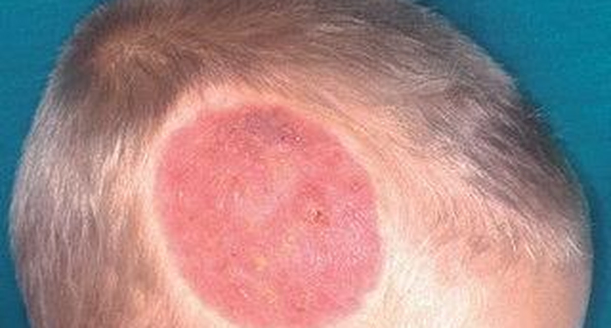 Grzybica strzygąca - przyczyny, objawy, diagnostyka i leczenie