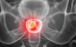 Już nie rak płuc! Ten nowotwór jest największym zabójcą mężczyzn w Polsce