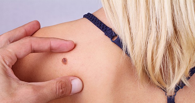 Így védje magát a melanomától