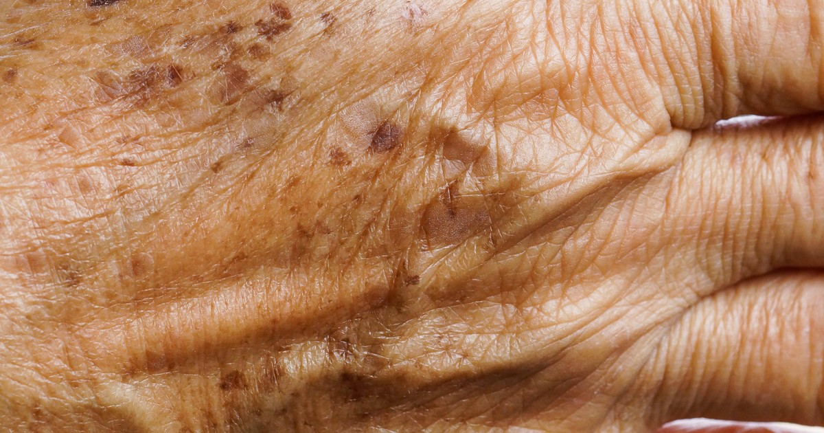 Plamy wątrobowe. Co oznaczają ciemne plamy na skórze?