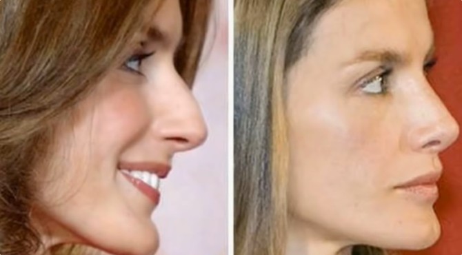 Kraljica Leticija pre i posle plastične operacije 