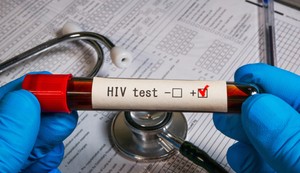 Značajan broj ljudi žive sa HIV-om, a da toga nisu svesni, zbog čega je rano i redovno testiranje ključno