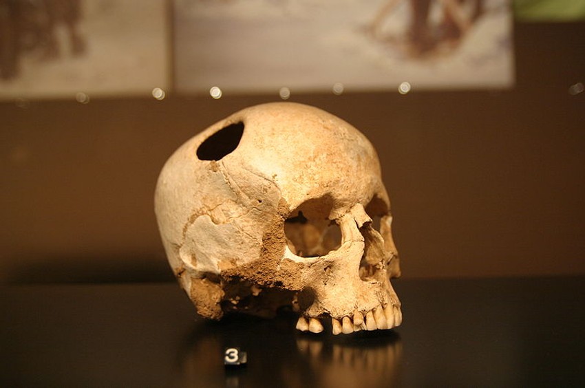 Trepanacija