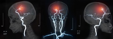 A stroke-on átesett betegeknek nagyobb az esélye egy újabb stroke bekövetkezésére vagy súlyos szívritmuszavarra, a szoros ellenőrzés és a gyógyszeres stroke-prevenció - ami leggyakrabban a vérlemezkék-összecsapódását gátló kezelés - emiatt is fontos.