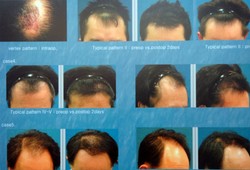 Turcja stała się światowym centrum przeszczepu włosów